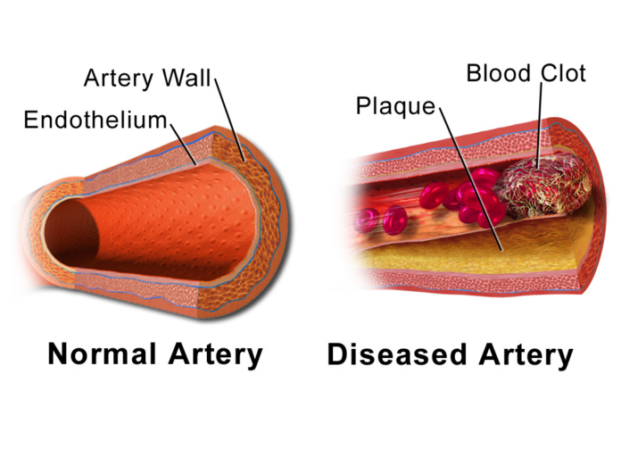 Blausen_0053_Artery_NormalvsDiseasedVessel